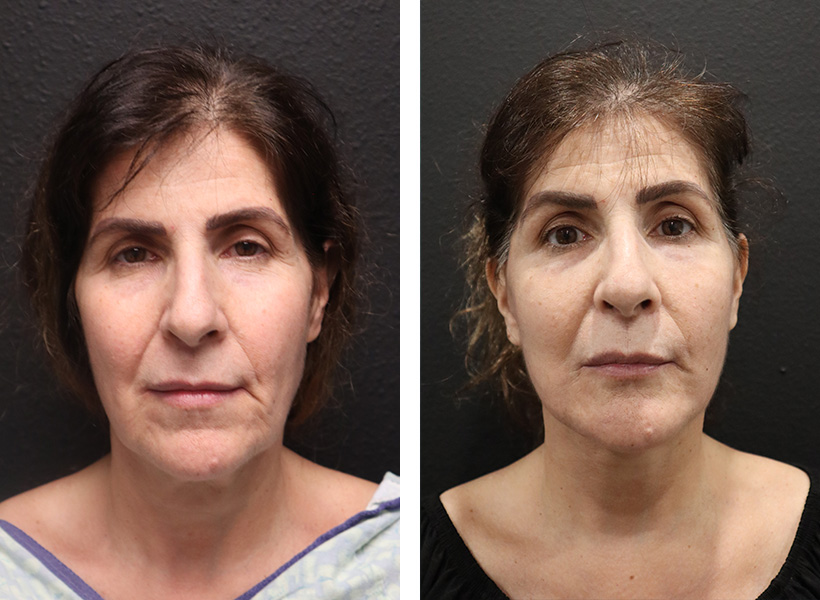 Facelift Case Sarasota Surgical Arts