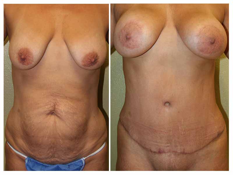 Mommy Makeover, Tummy Tuck, hip liposuction, and Saline Breast Augmentation...