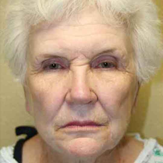 Brow Lift Case 12 - Sarasota Surgical Arts